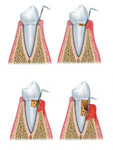periodoncia-rob-dental-badalona