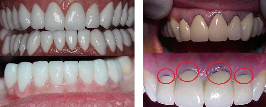 Parlamento Intolerable conciencia Tratamiento de fundas estéticas de zircónio - Clínica Dental Rob