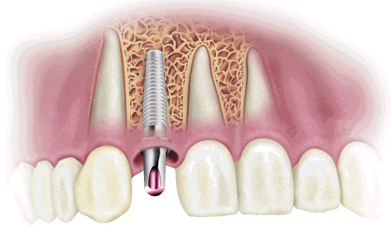 implantes dentales, ROB dental, clinica dental Badalona, estética dental