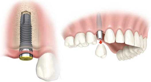 claves sobre implantes dentales