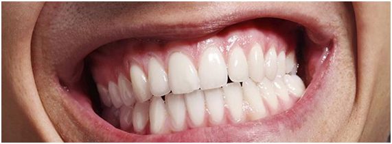 La oclusión dental, los implantes y el bruxismo