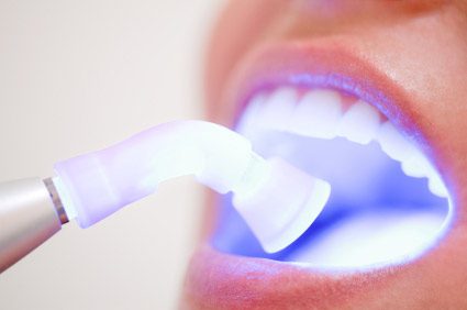 Blanqueamiento dental Mitos y realidades