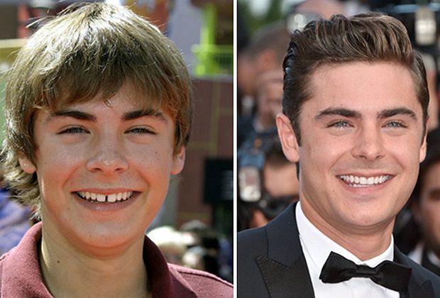 ZAK EFRON DIENTES NUEVOS