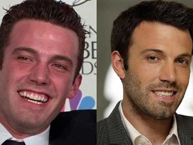 implantes dentales ben affleck clinica-rob badalona