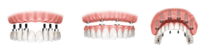 implantes en un dia