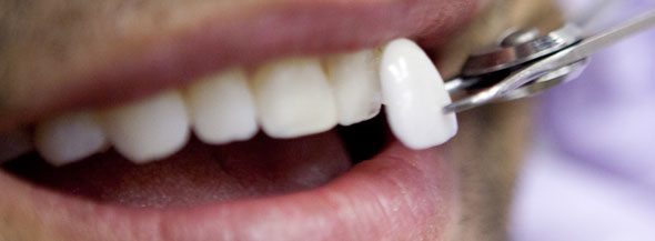 Consigue la sonrisa con la que sueñas con las carillas dentales - Clínica  Dental Valvanera