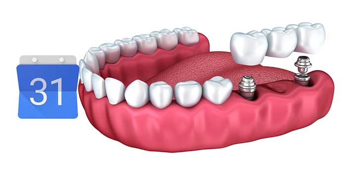 Qué tiempo dura un implante dental