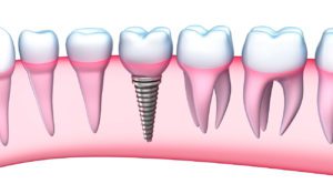implantes dentales badalona