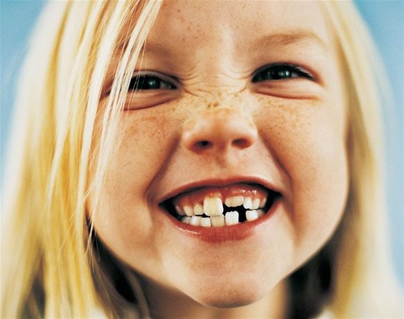 Ortodoncia preventiva en niños