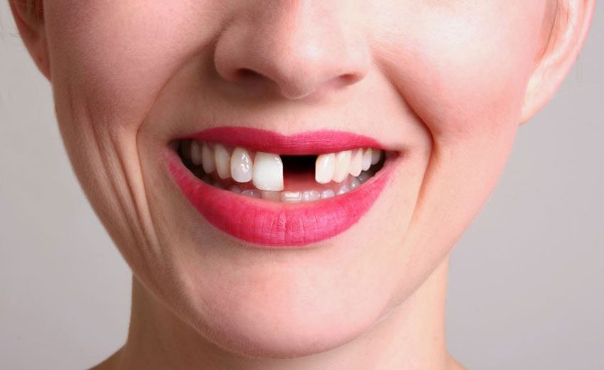 Qué hacer al perder un diente clinica dental rob