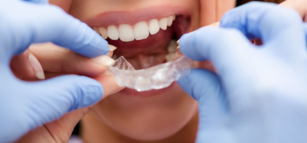 Tratamiento de bruxismo - Férula de descarga dental