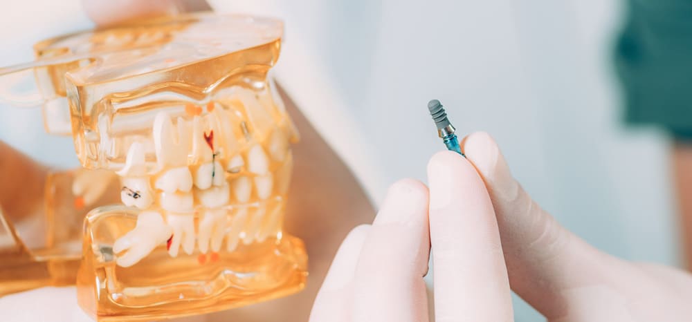 Implantes dentales en Badalona - clínica dental Rob