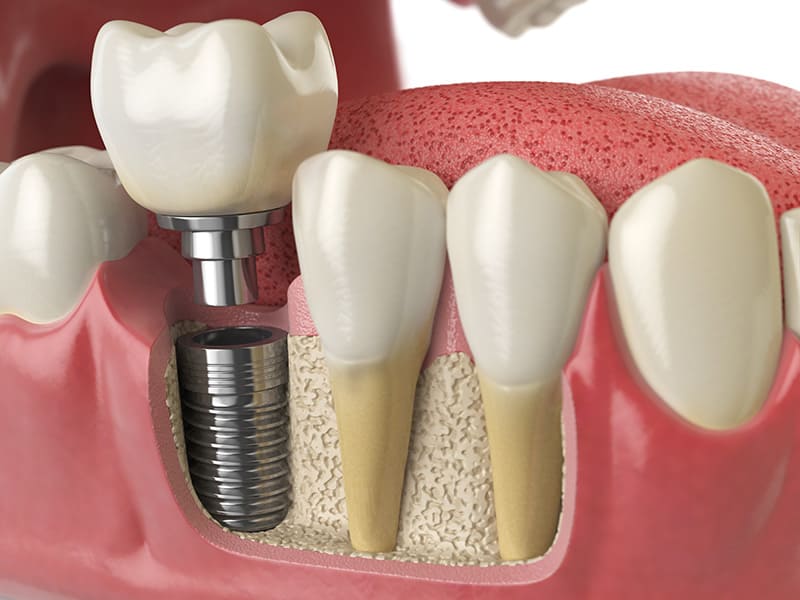 implantes dentales Badalona