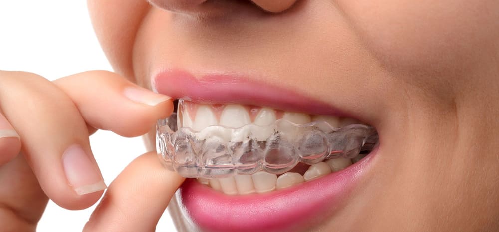 Invisalign Badalona