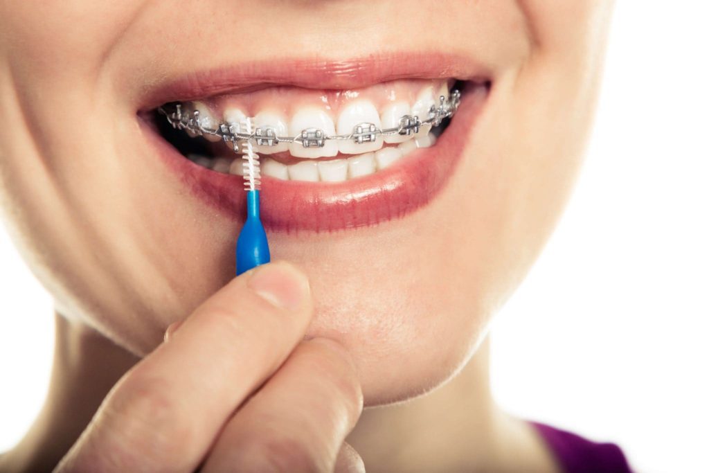 Cómo cepillarte los dientes con brackets - Rob Dental