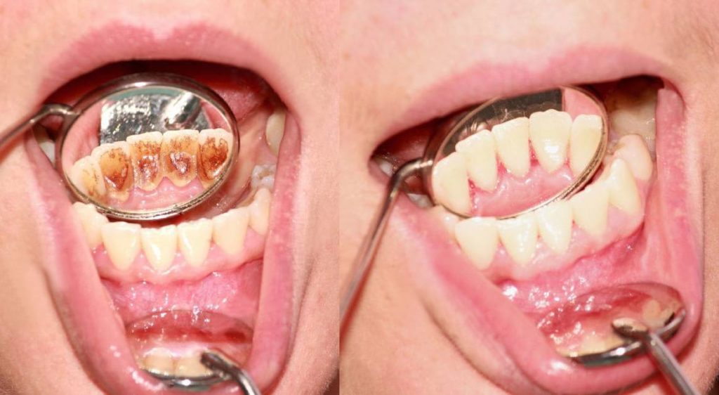 Por qué se forma el sarro en los dientes y cómo podemos eliminarlo