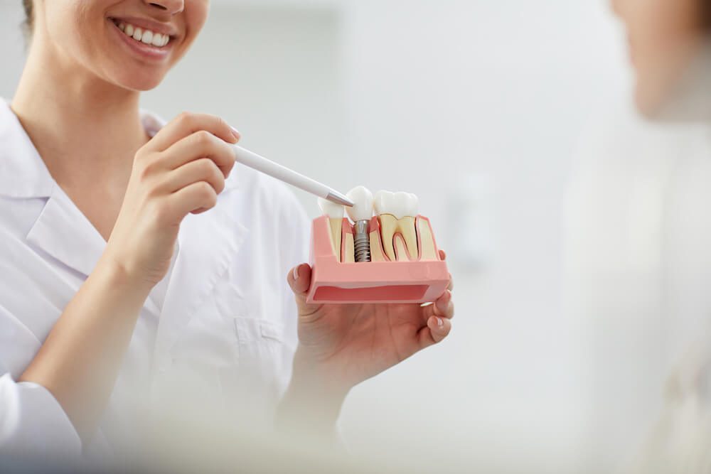 cosas que debes saber sobre los implantes dentales