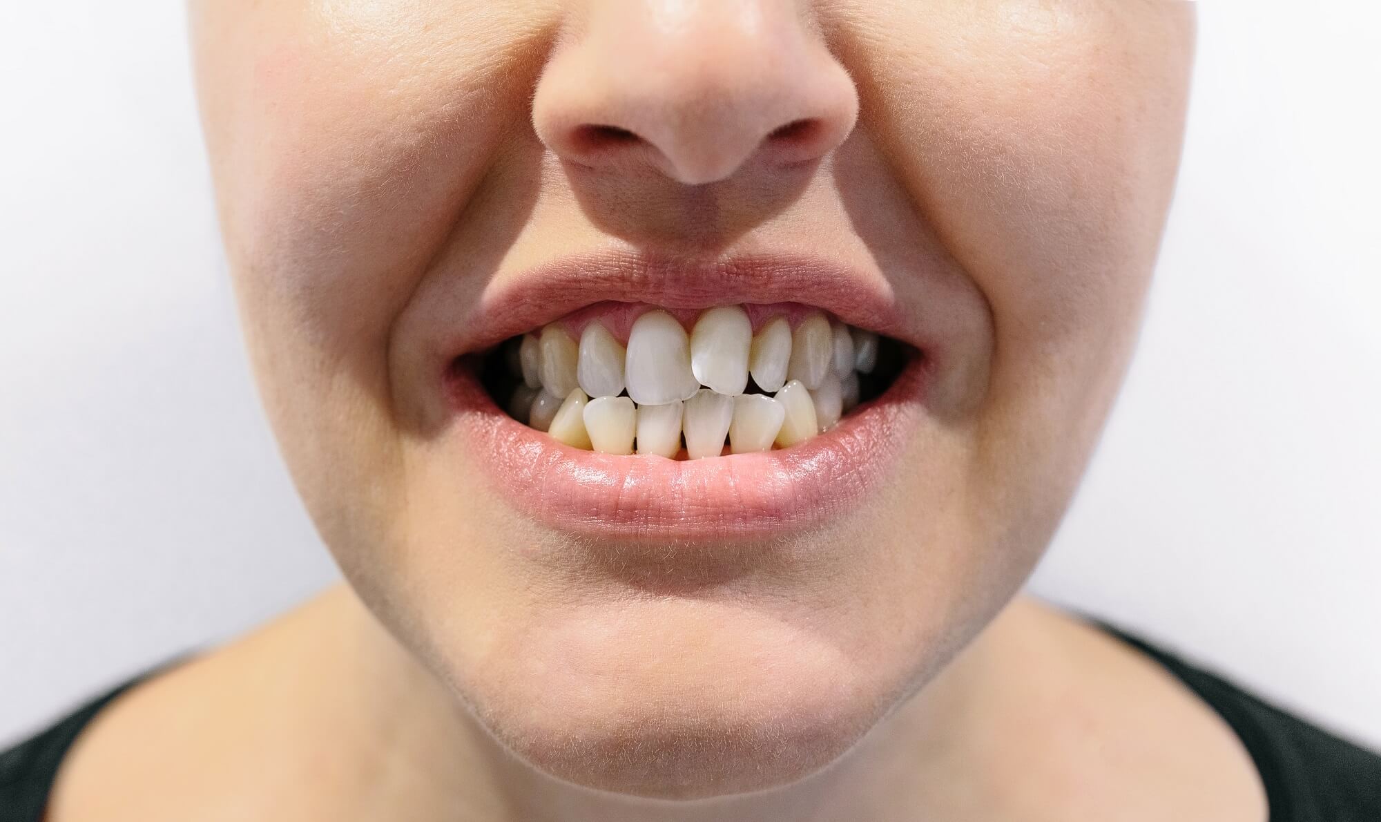 Cuál es la solución para unos dientes apiñados