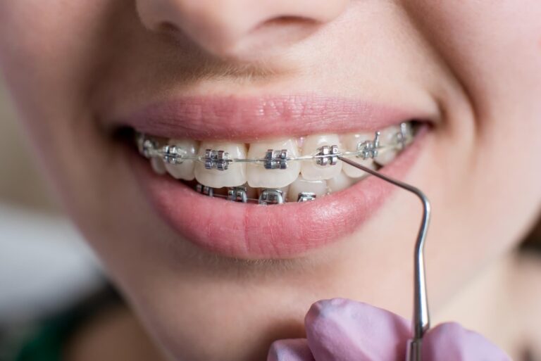 A qué se debe el dolor cuando te colocan brackets