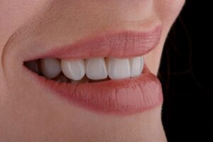 cuánto duran las carillas dentales