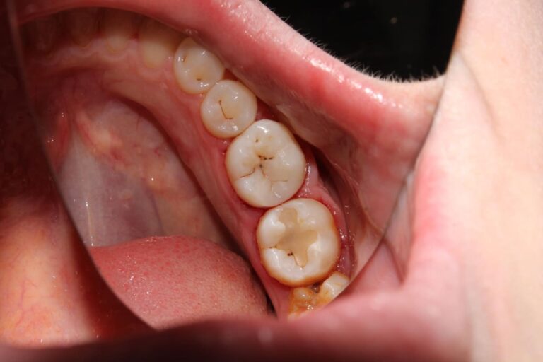 por qué salen las caries